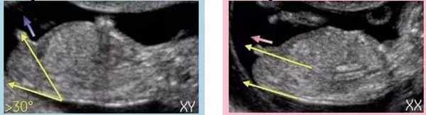 孕三个月已验证生女儿检查图片，NT值1.2mm是男是女快看